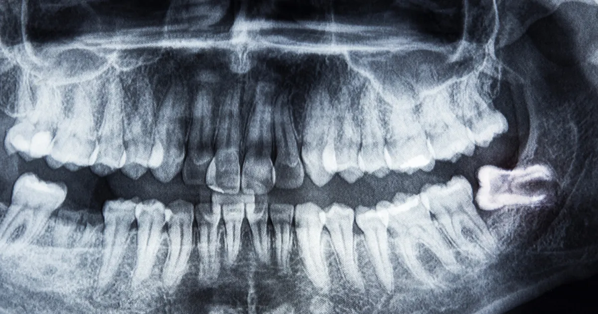 親知らずを抜歯する際の医院の選び方