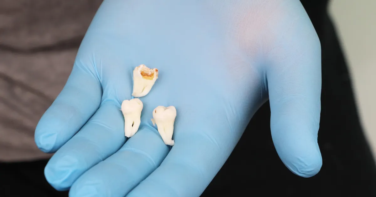 親知らず抜歯で腫れやすい理由