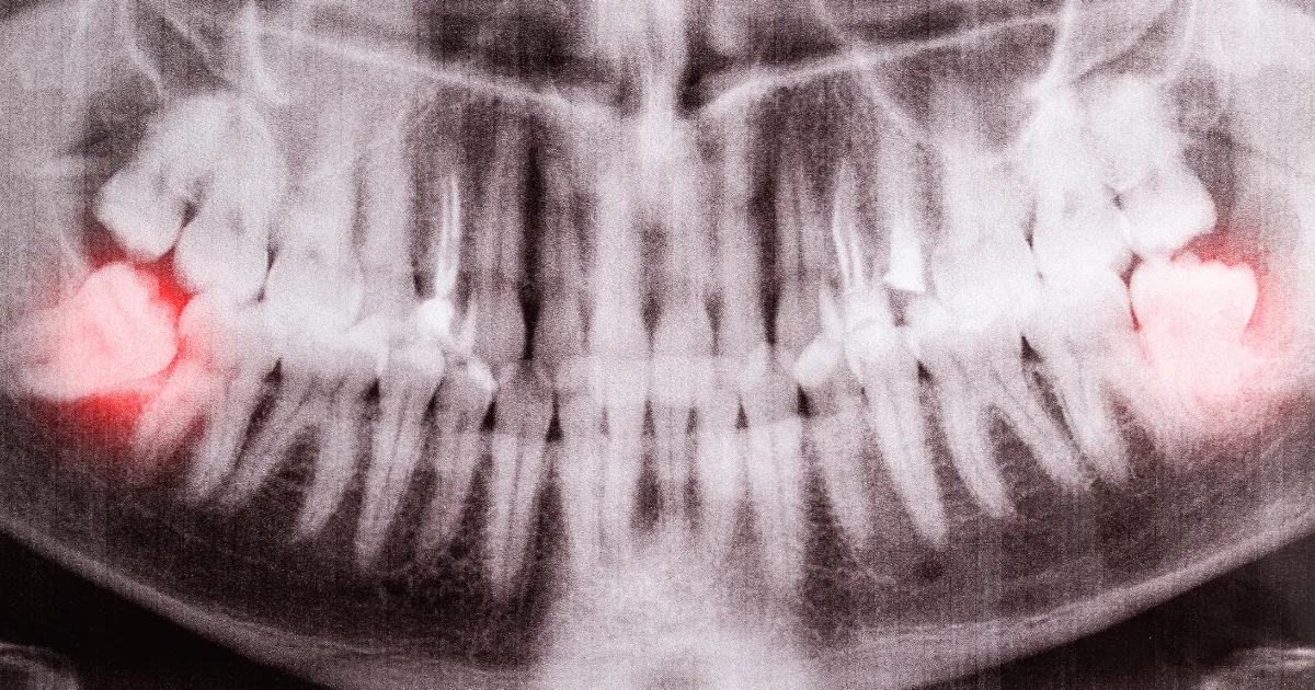 親知らずは何歳で抜くべきか？
