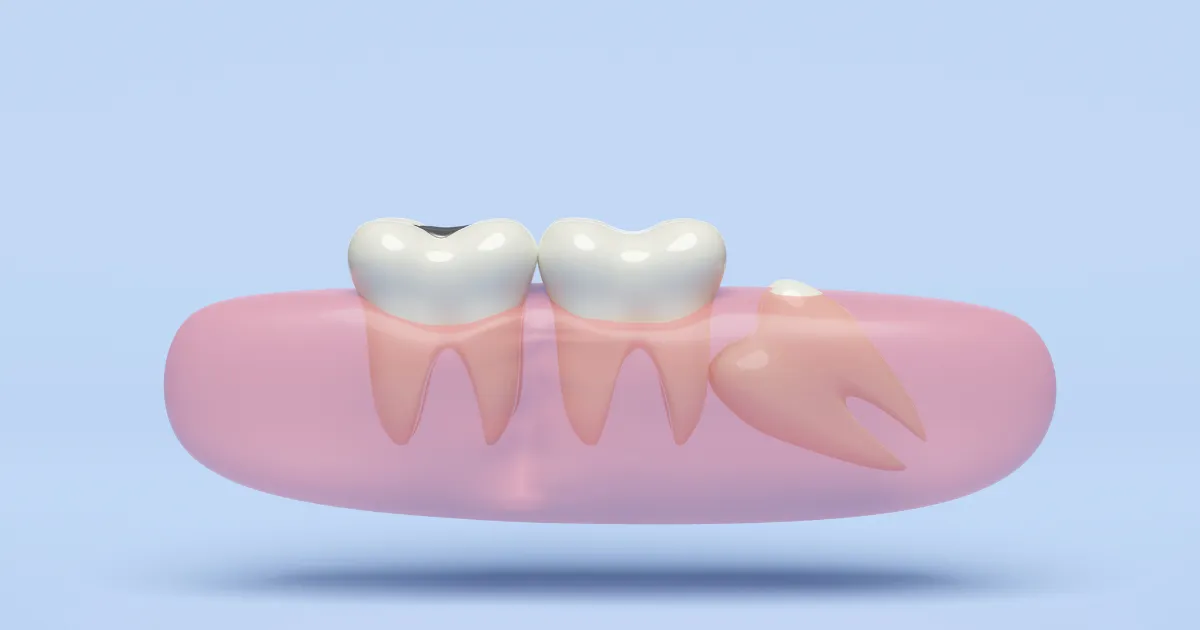 親知らずの抜歯が必要な状況