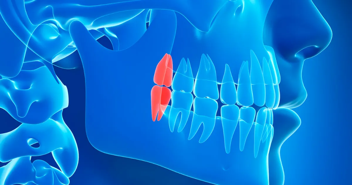 親知らず抜歯後の痛みに耐えられないと感じる期間