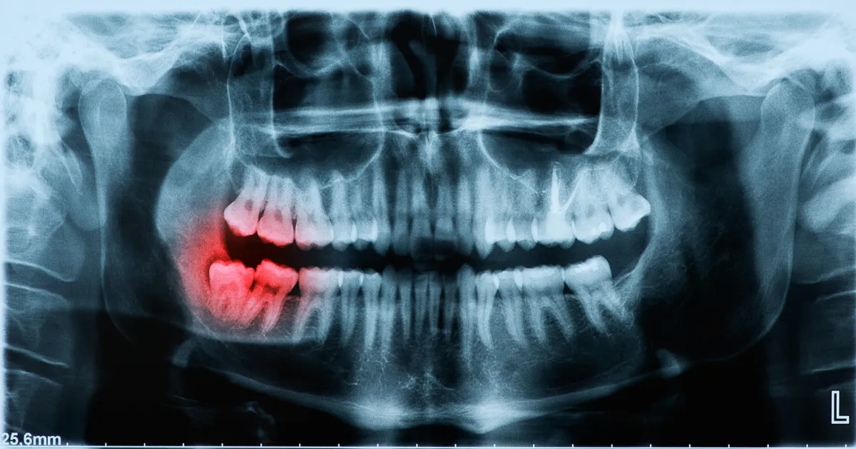 親知らずを抜くべきかの判断基準