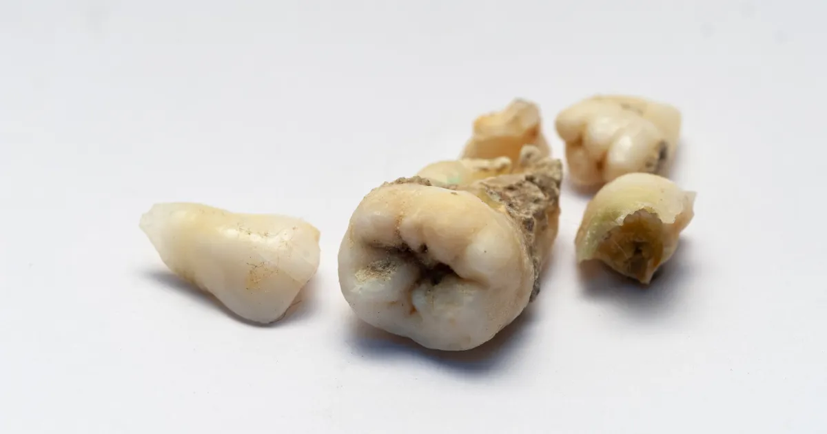 智齿萌出的具体年龄段和特殊性