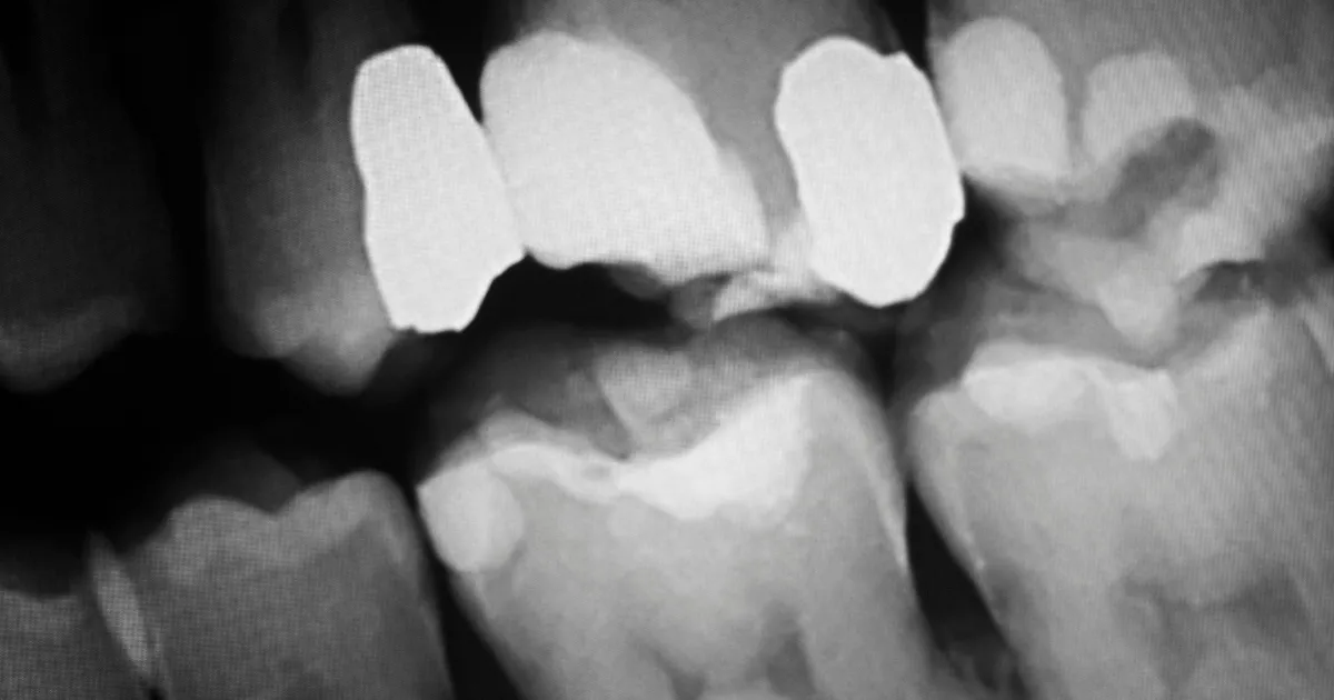 親知らずを抜歯するデメリット3選