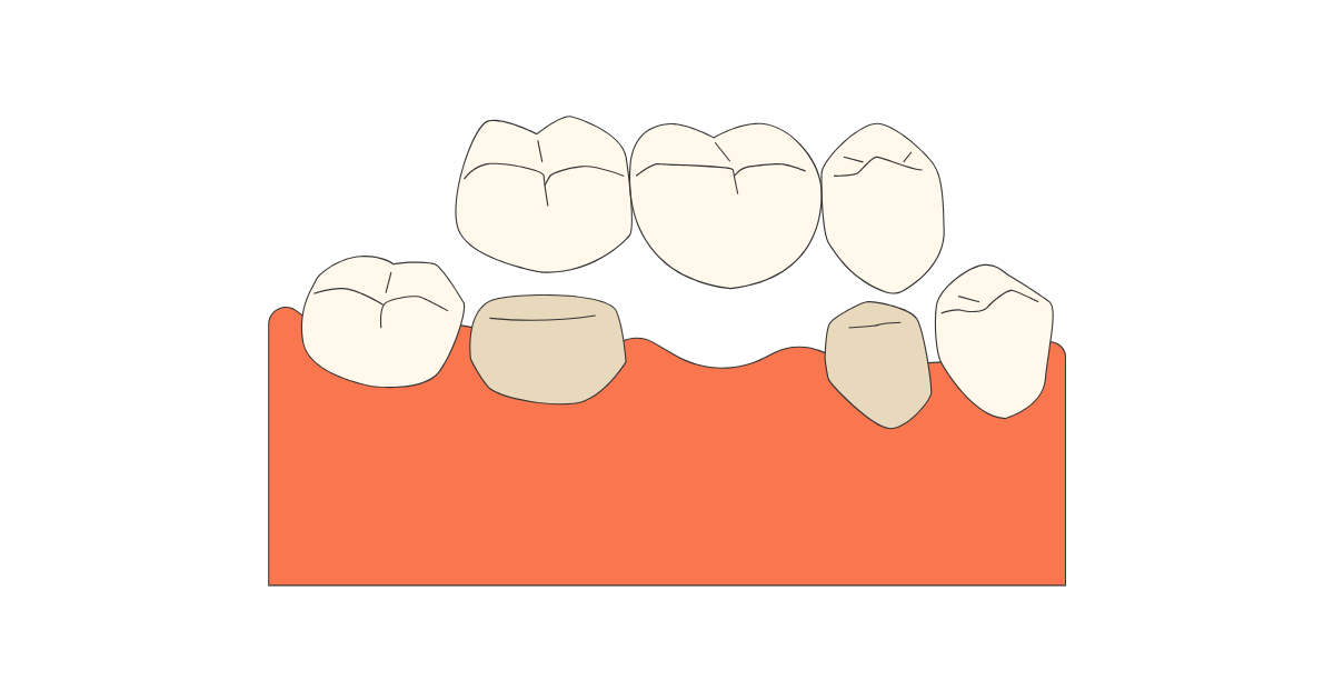 歯科ブリッジとは？基本の仕組みをわかりやすく解説