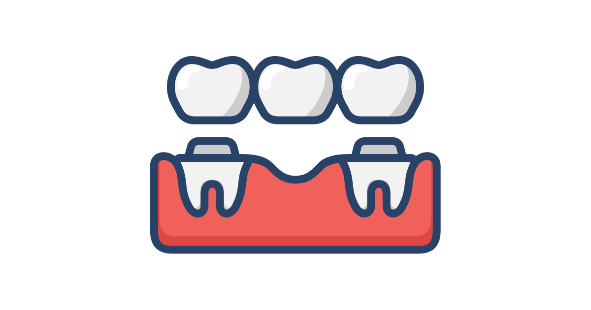 歯科ブリッジが選ばれる理由｜メリットとデメリット