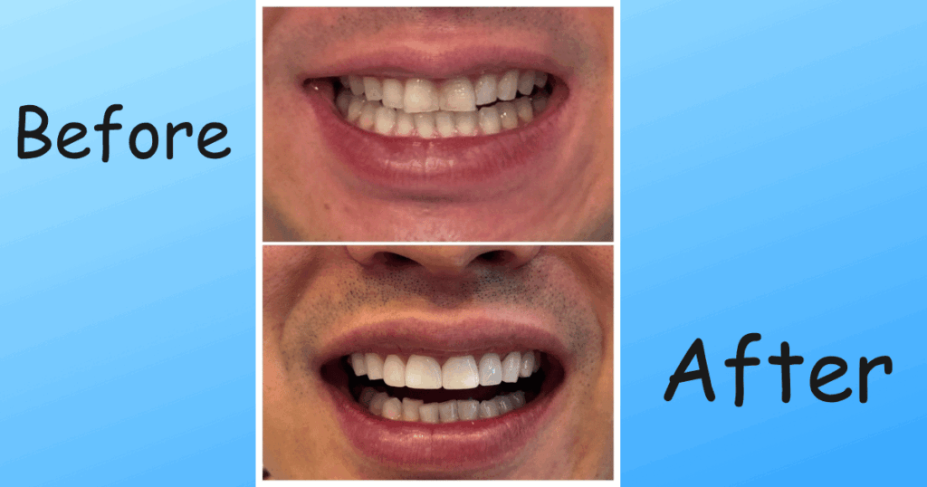 赤崎理事長も体験！削らないベニアを高田88で装着しました