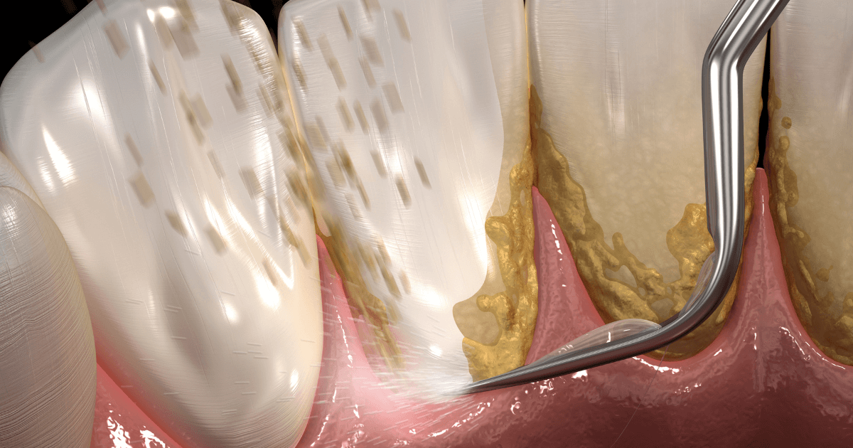歯のクリーニング：メリットから適切な頻度まで丸ごと解説