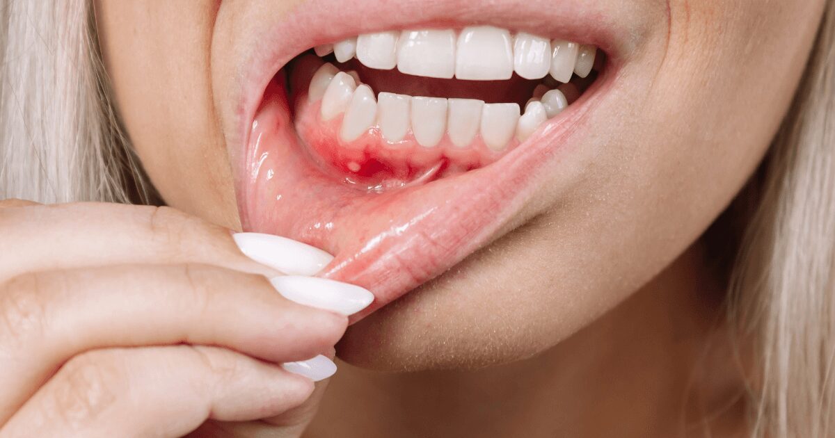 歯周病の進行段階について