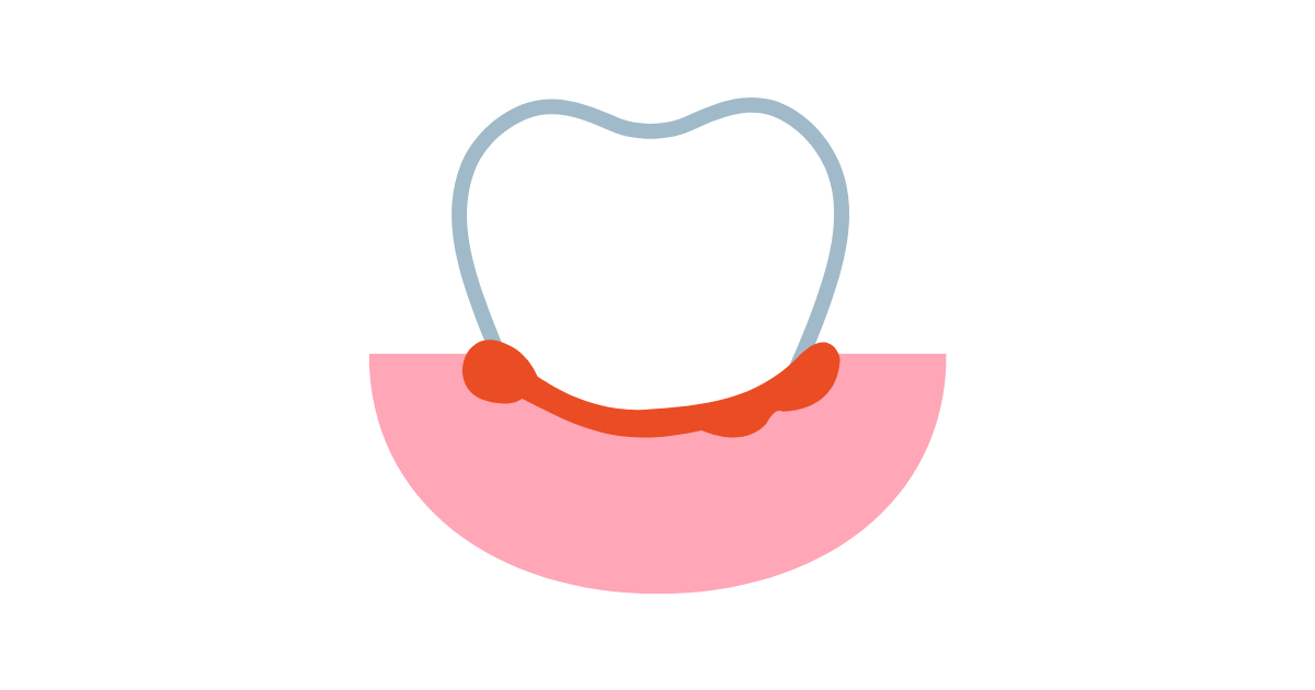 歯周病治療後のメンテナンスが重要な理由