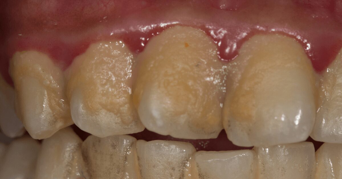 歯周病の原因と進行メカニズム