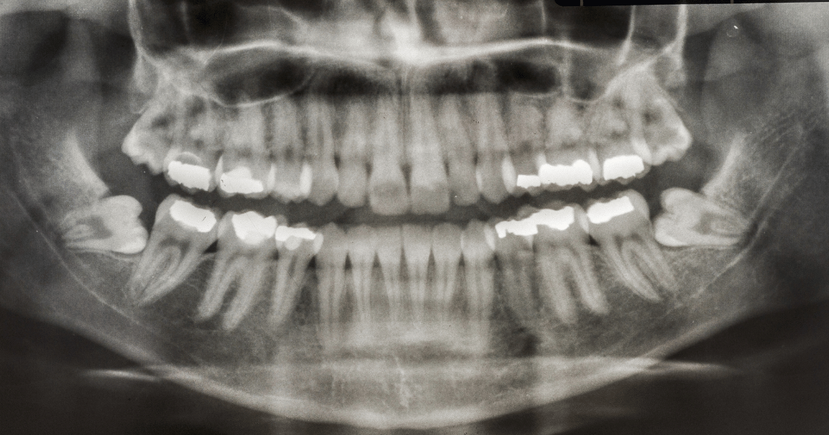親知らず抜歯後の日常生活で気をつけるべきこと