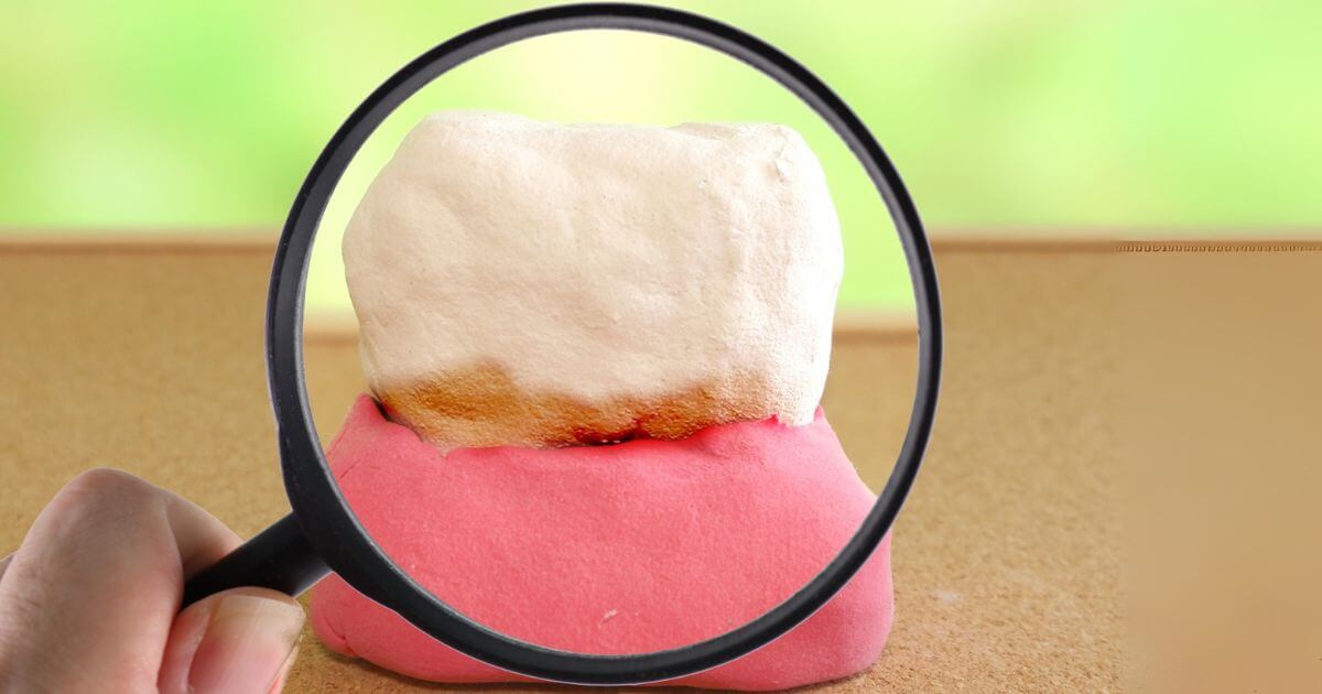 虫眼鏡で歯と歯茎の異常を確認している模型