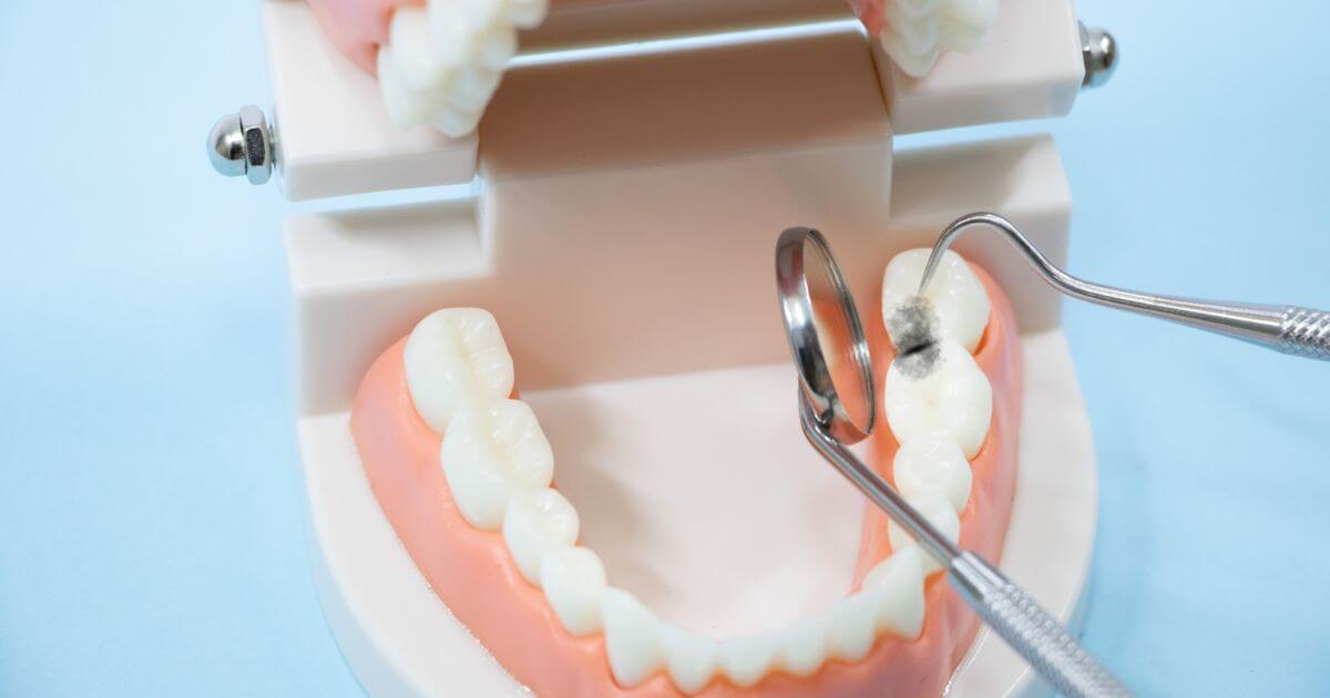 歯と歯の間にできた虫歯を示す歯科模型の写真