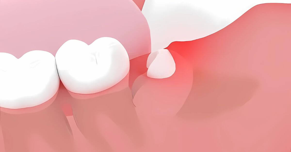 斜めに生えている親知らずのイメージイラスト