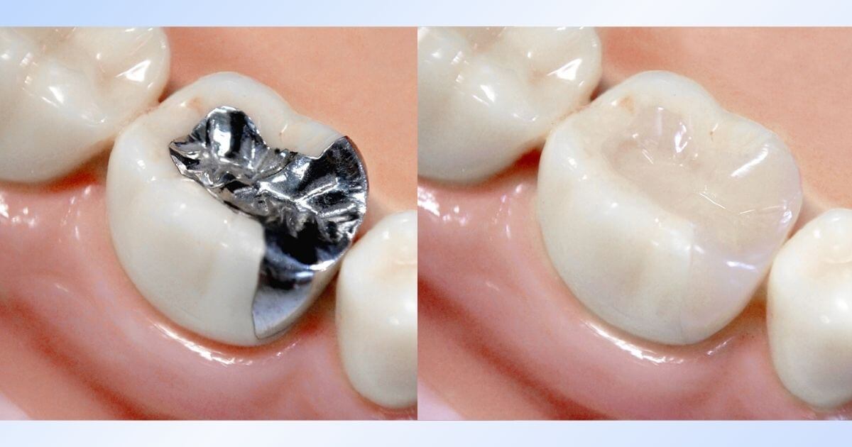 銀歯とセラミック治療後の比較