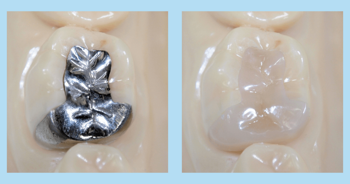 銀歯と白い詰め物を比較した歯の模型