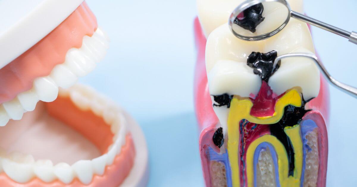 歯の断面模型で示された虫歯の進行状態