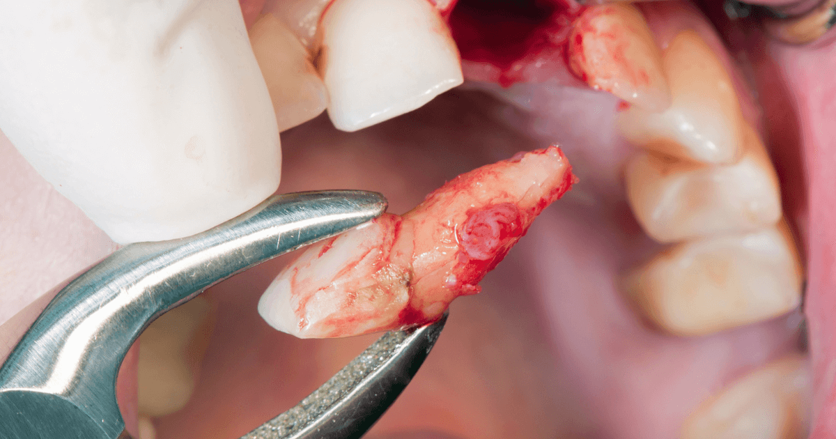 抜歯後の歯茎の様子