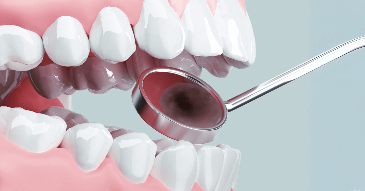 歯科用ミラーで歯の横の虫歯を確認する様子
