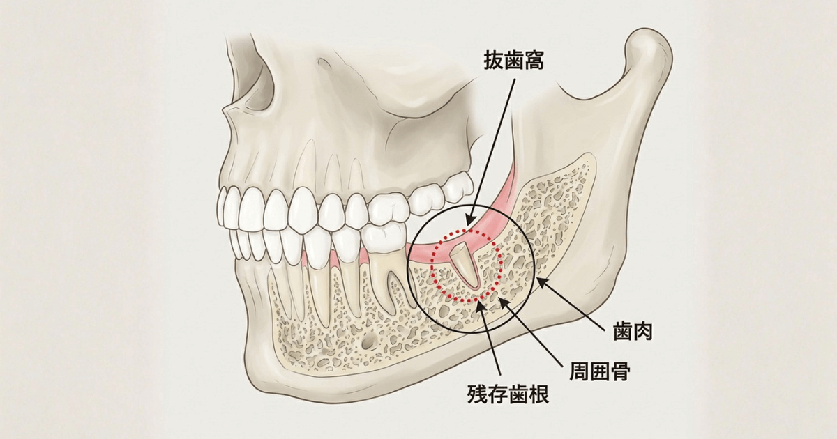 親知らずを抜歯したあとに根っこが残っている状態を示した図