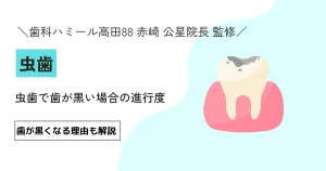 【9割が知らない】虫歯で歯が黒い場合の進行度｜歯が黒くなる理由も解説