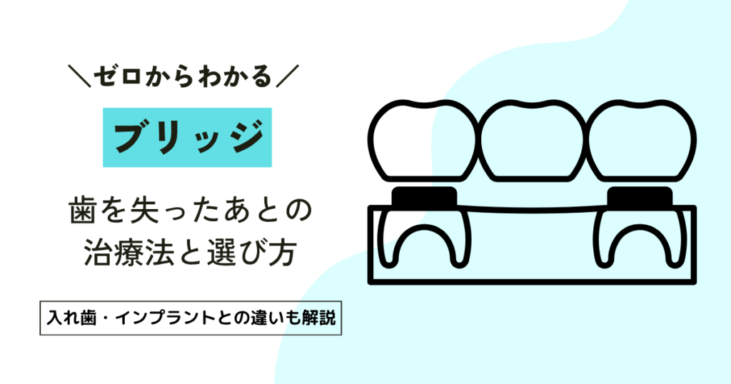 歯を抜いたあと、ブリッジを選ぶ前に知っておきたい5つのポイント