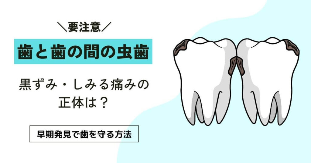歯と歯の間の虫歯｜早期発見と予防の完全ガイド