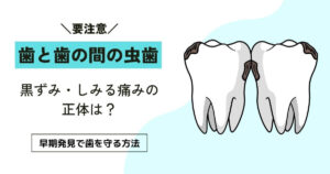 歯と歯の間の虫歯｜早期発見と予防の完全ガイド