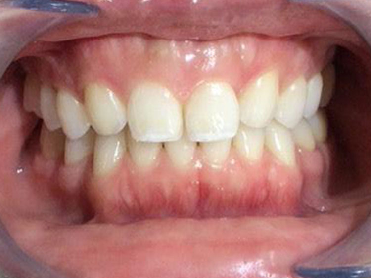BEFORE