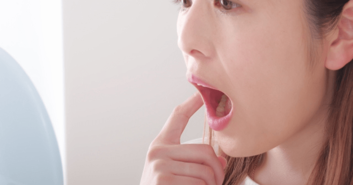 親知らず抜歯後　口の中の状態