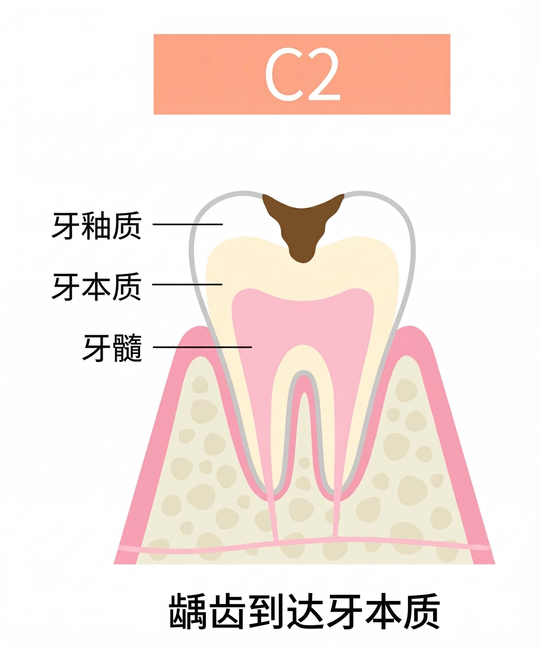 龋齿治疗｜东京高田马场牙科诊所