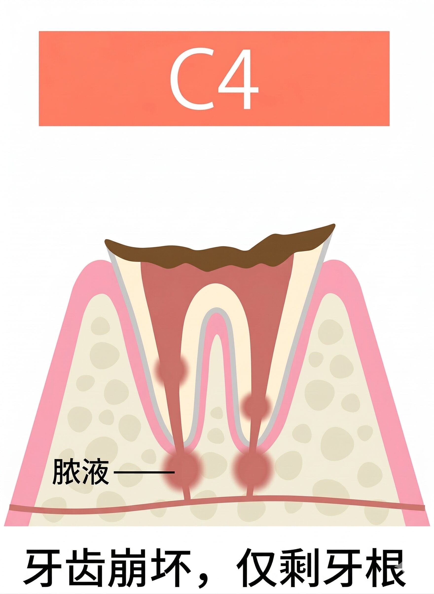 龋齿治疗｜东京高田马场牙科诊所