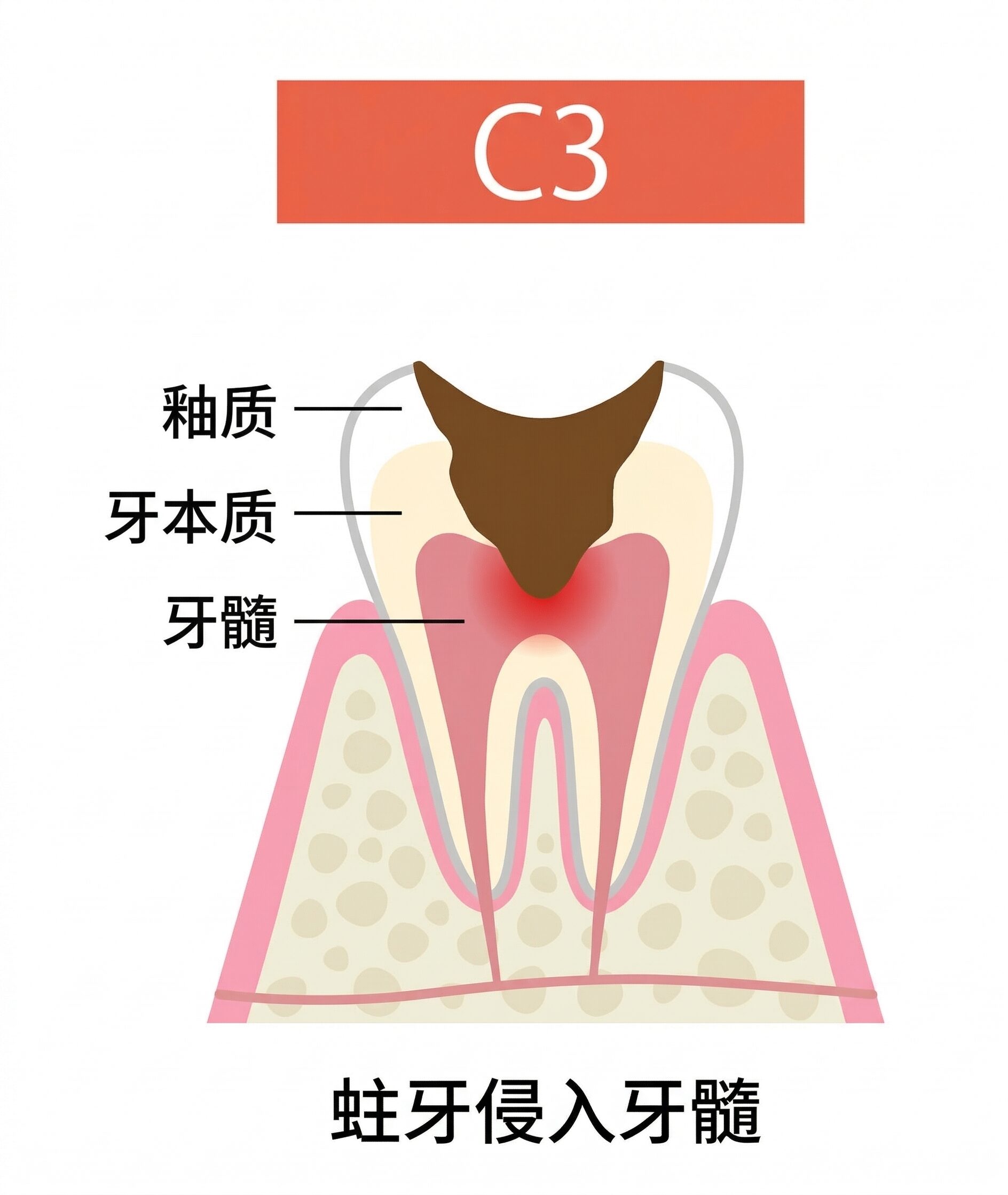 龋齿治疗｜东京高田马场牙科诊所
