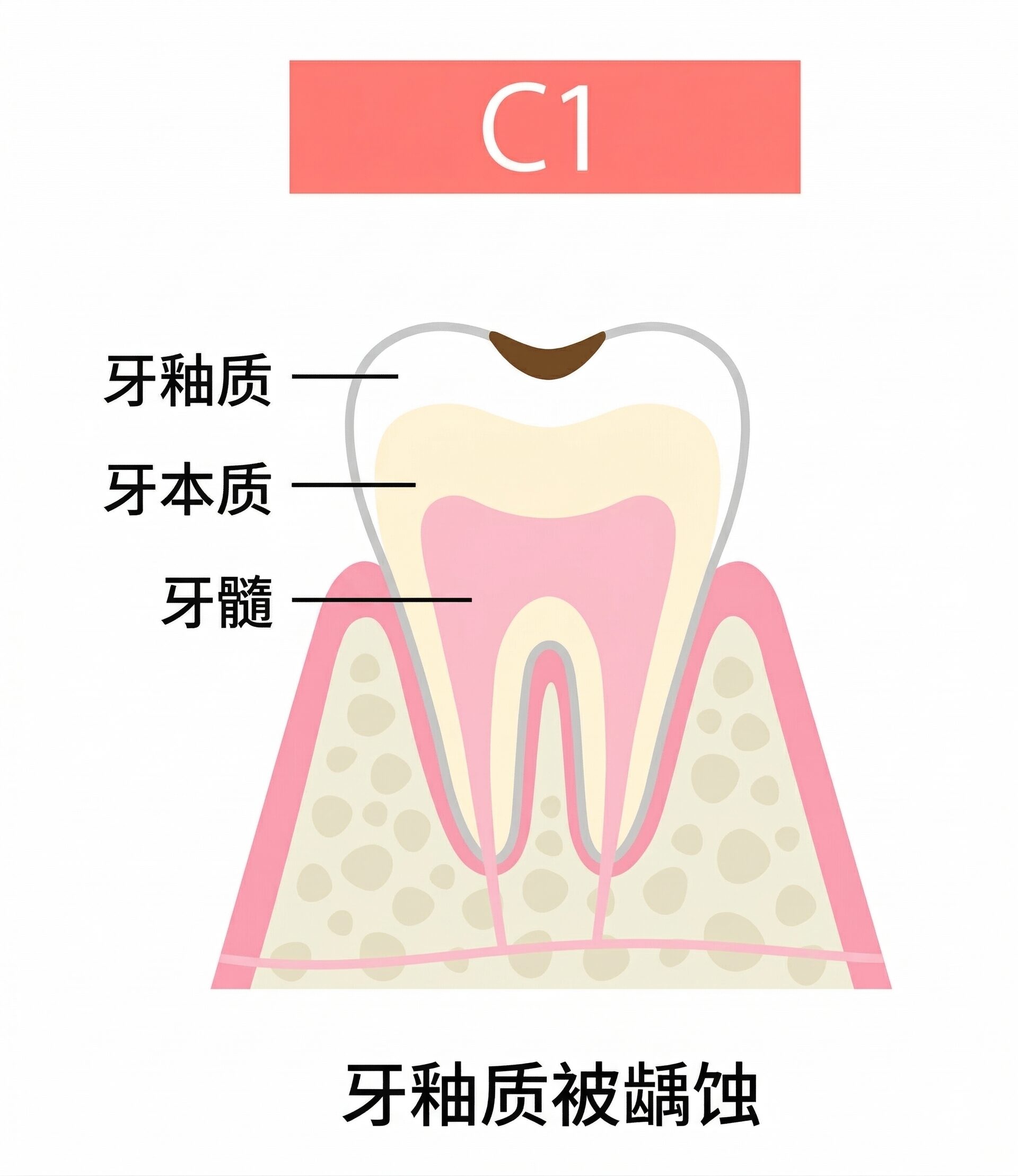 龋齿治疗｜东京高田马场牙科诊所