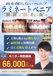 【4月スタート】ラミネートベニア特別モニター募集のお知らせ