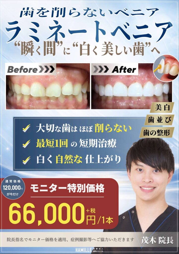 【4月スタート】歯を削らない「ラミネートベニア」特別モニター募集のお知らせ