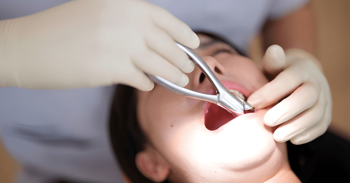 親知らず 抜歯後 痛み 経過