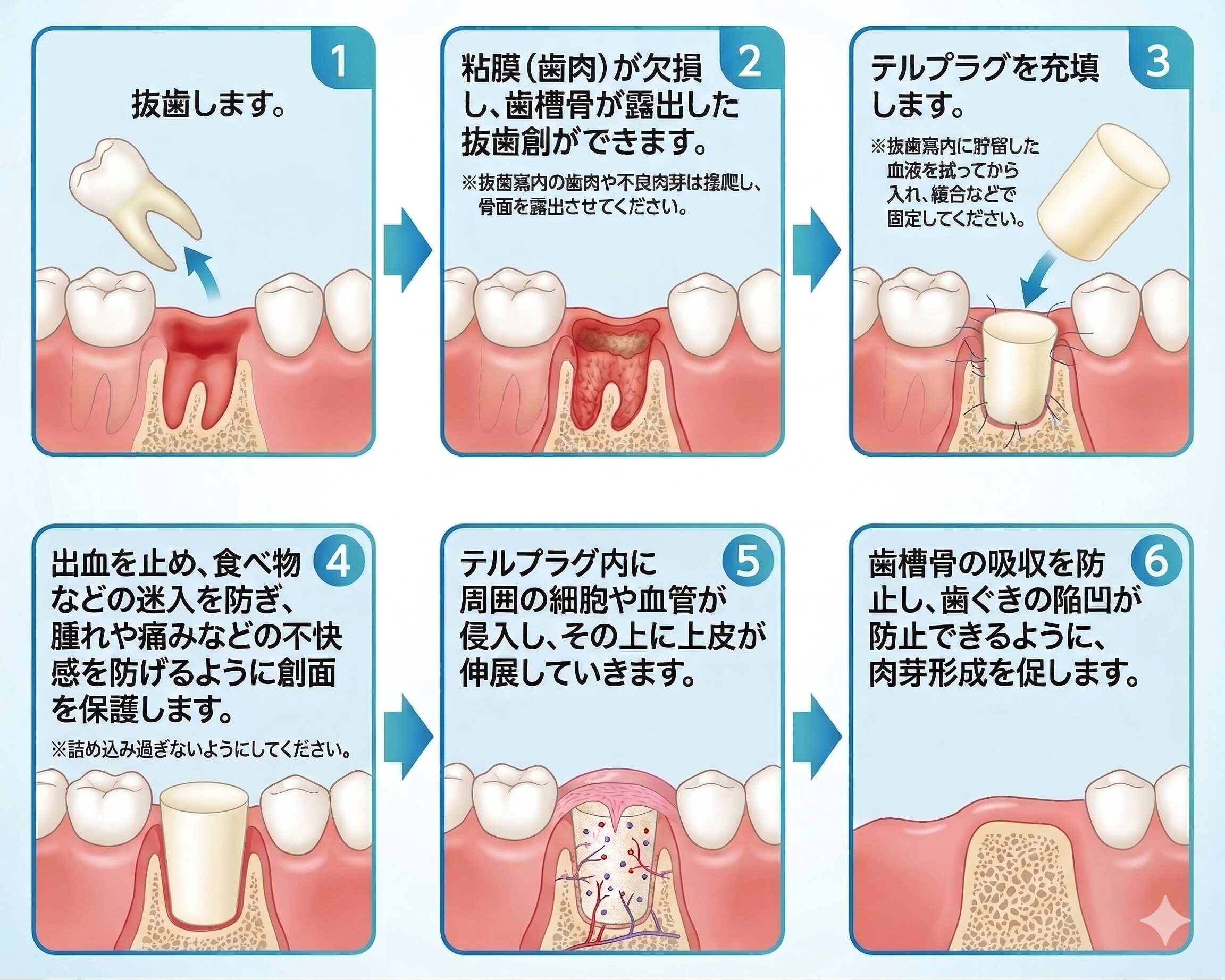 歯科ハミール高田88の親知らずの抜歯