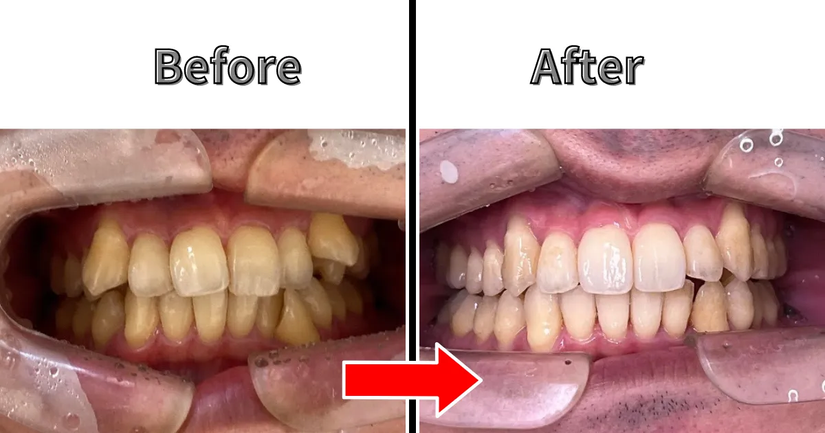 什么是Invisalign1