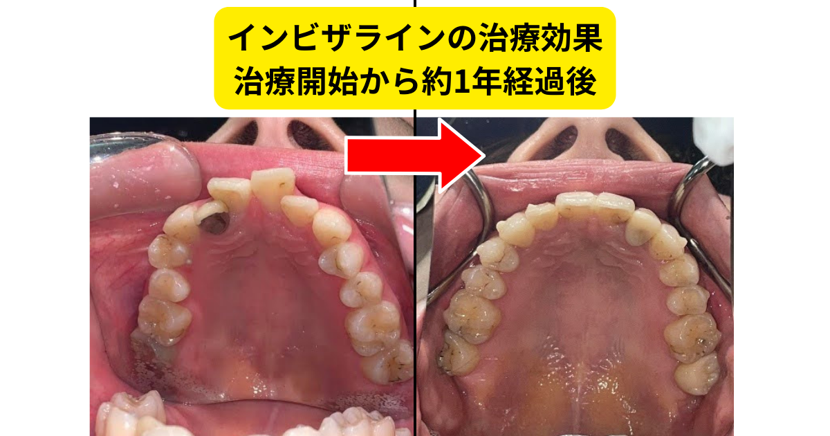 インビザラインの治療効果①