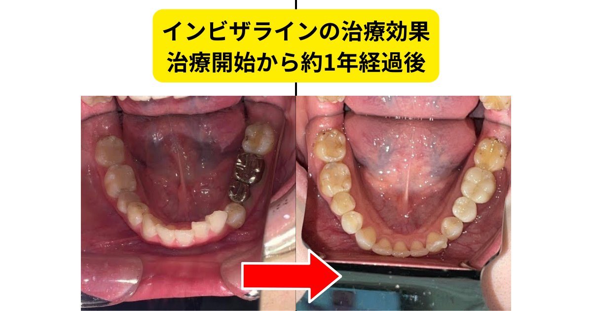 インビザラインの治療効果②