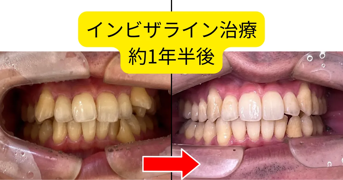 【症例】インビザライン治療(1年半くらい治療している患者さんです)①