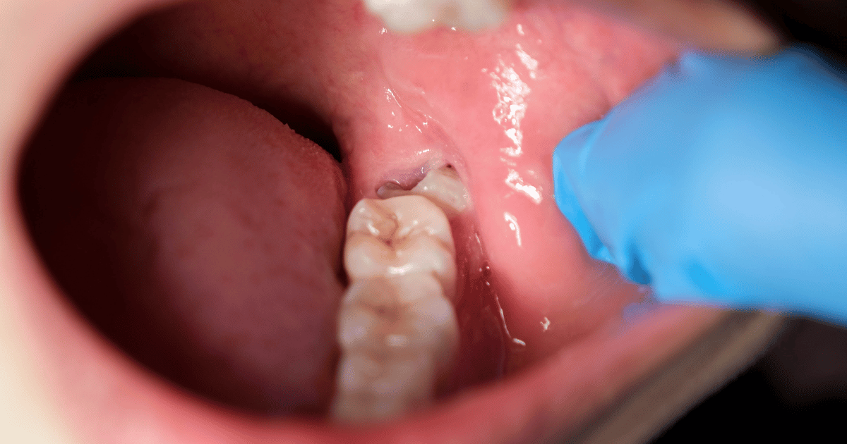 親知らず抜歯後に注意すべき症状と、歯医者に行くべきサイン