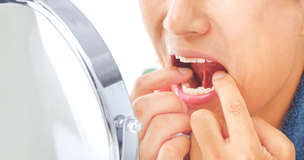 抜歯後の傷口を鏡で確認している男性の口腔内の様子