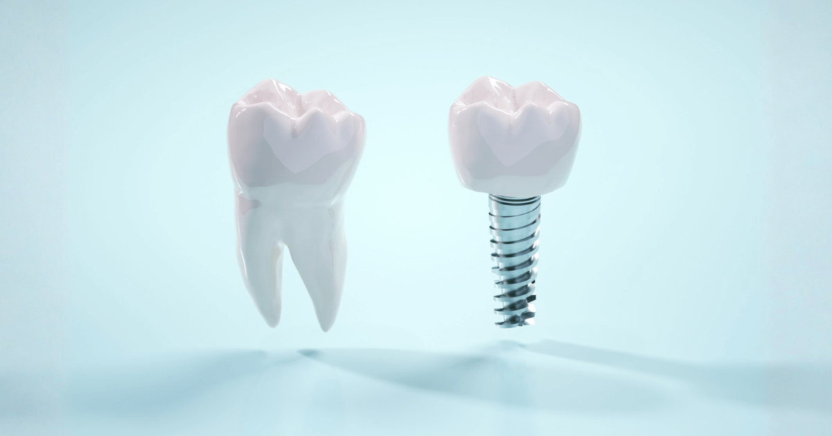 インプラントとセラミックの基本的な違いを示したイメージ
