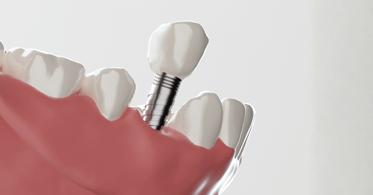 インプラント治療の流れや治療期間の違いを示すイメージ