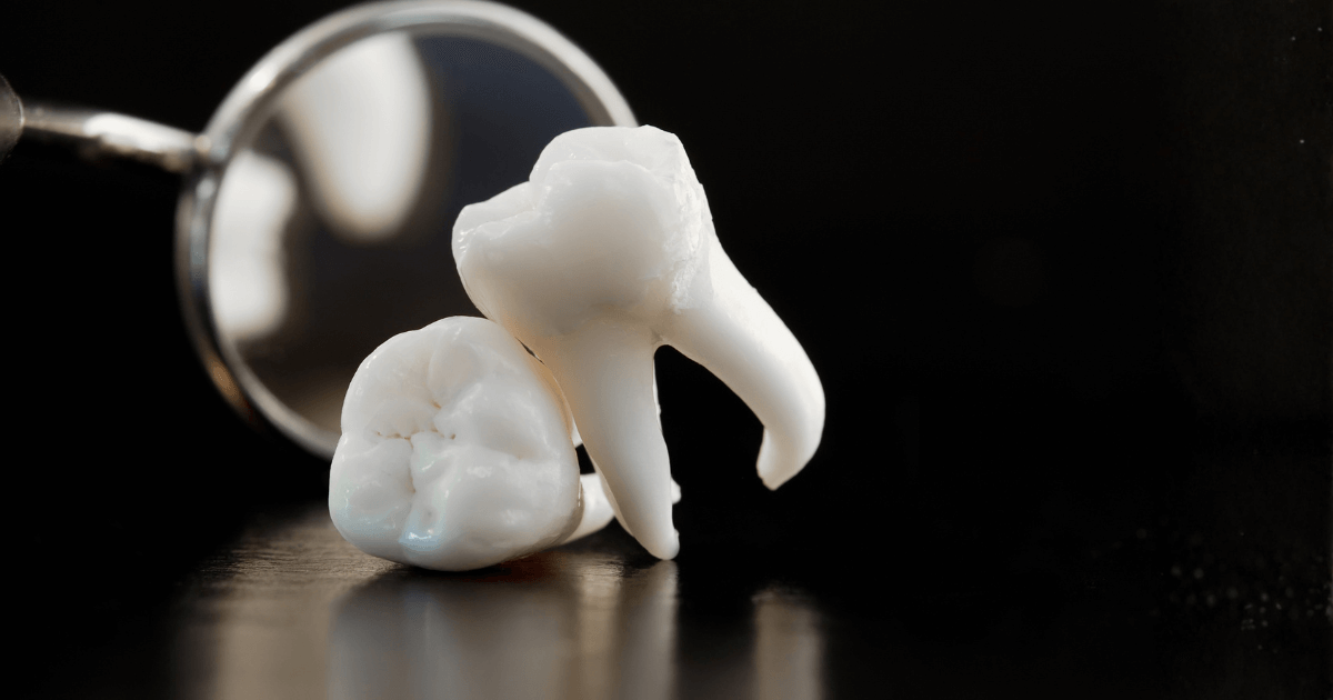 親知らずの生え方や状態の違いを示す歯のイメージ