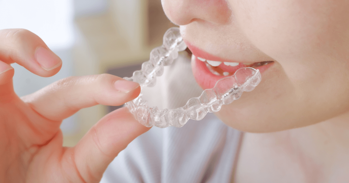 奥歯を守るためにマウスピースを装着しようとしている女性の口元